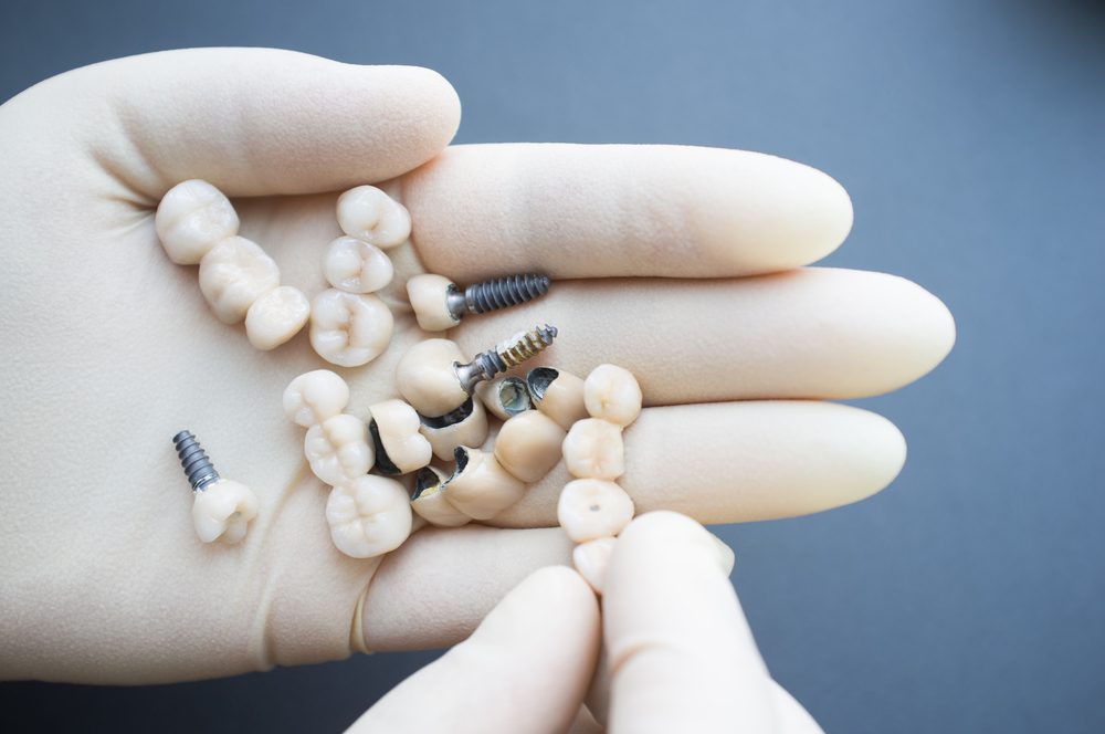 A person grips a tooth and a screw, symbolizing parts of full mouth dental implants in relation to their overall costs