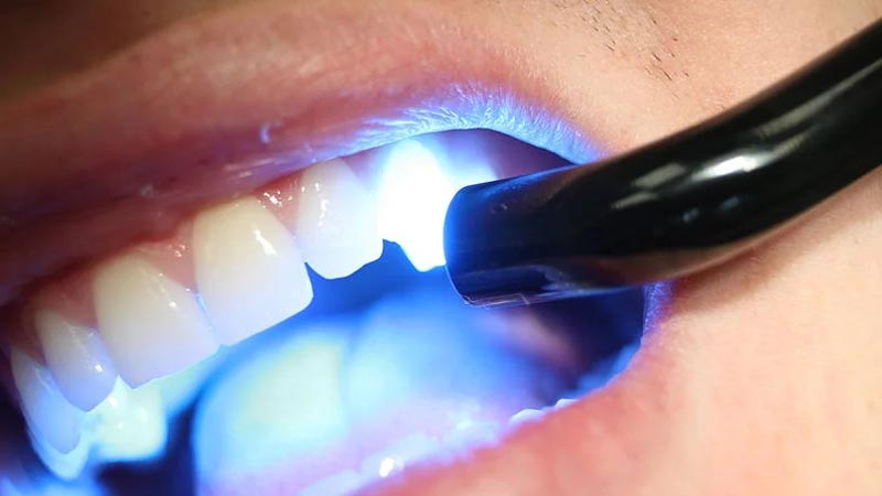 tooth restoration using a composite