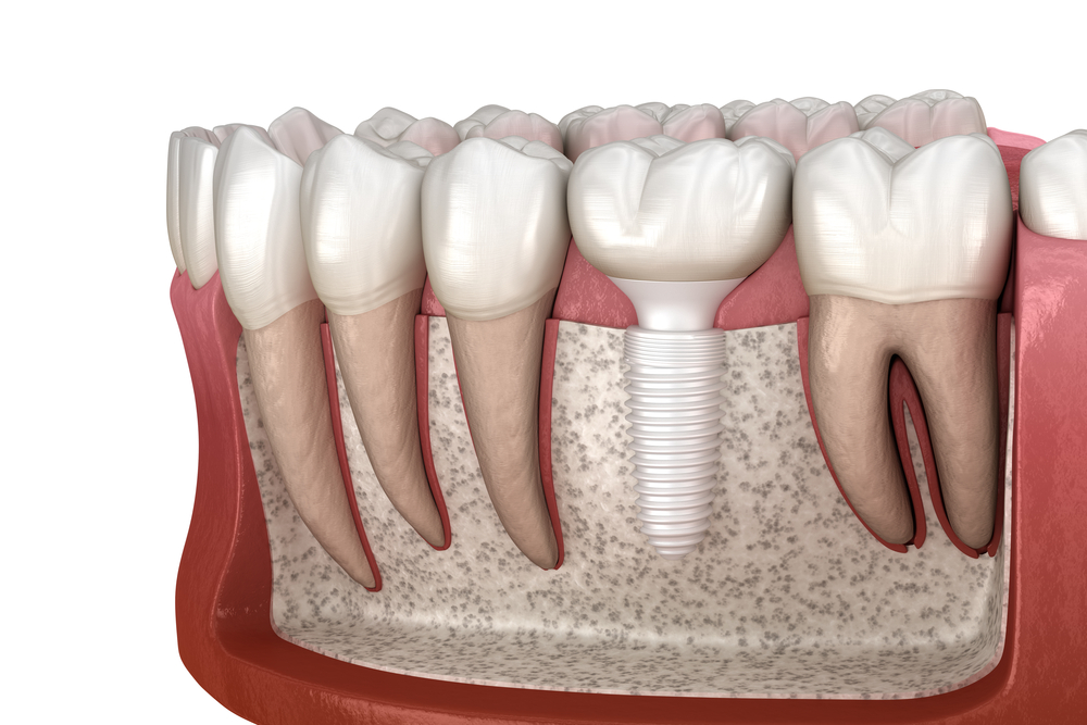 ceramic dental implant illustration