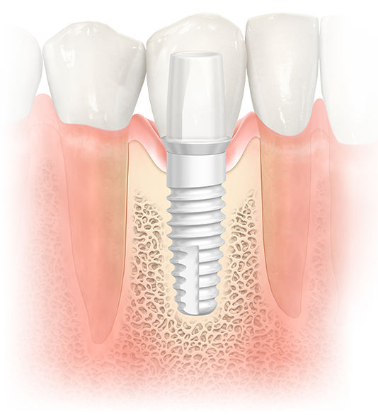 Ceramic Dental Implant