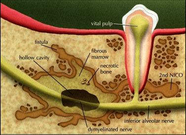 surgery - cavitation